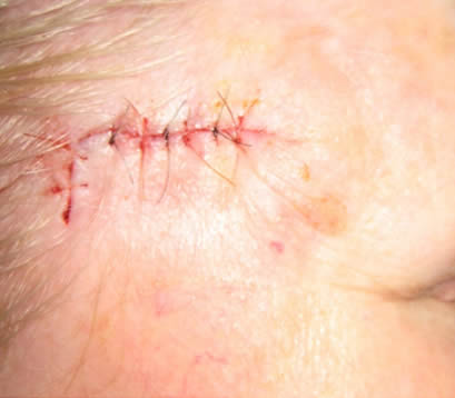 Closed Wound After Mohs Surgery Closeup of closed wound on forehead after Mohs surgery