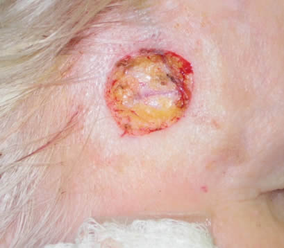 Open Wound After Mohs Surgery Closeup of open wound on forehead of older female after Mohs surgery