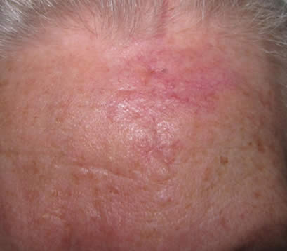 2 months after MOHS surgery 2 month after MOHS surgery for skin cancer on forehead