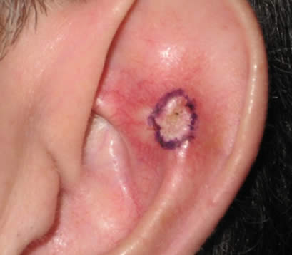 Left ear with skin cancer Skin cancer on left ear before MOHS surgery