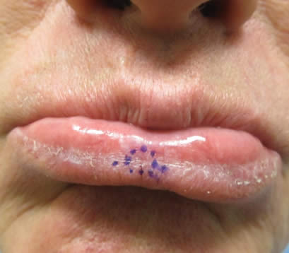 Lower lip with skin cancer Skin cancer on lower lip before MOHS surgery