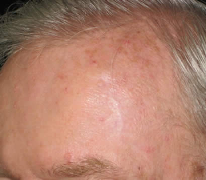 6 months after MOHS surgery Skin cancer on upper left side forehead after MOHS surgery 6 months