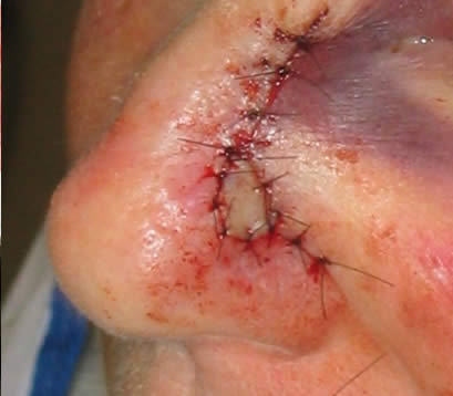 Wound closure after MOHS surgery Treating Skin cancer left side of nose after MOHS with closure and skin graft