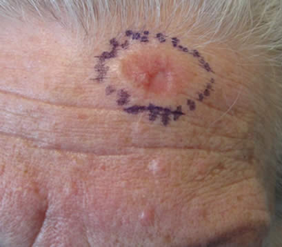 Skin cancer on forehead skin cancer before MOHS surgery on forehead